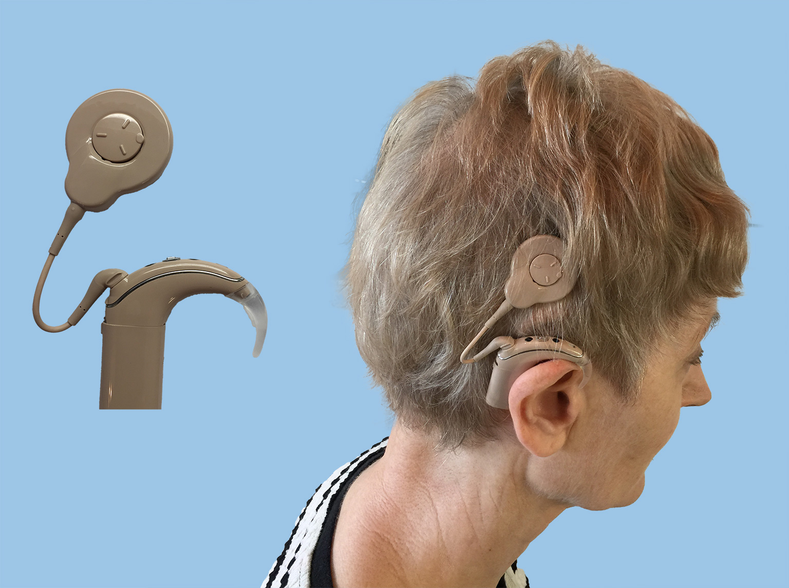 The External Component of a Cochlear Implant